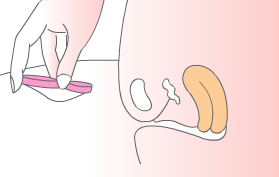 إدخال كوب حيض رقيق الجدران على شكل قرص/حلقة. ثم يتم ضغط جانبي الكوب معًا ووضعه في مكانه للإدخال.