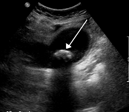 أظهرت صورة الموجات فوق الصوتية وجود حصاة مرارية بحجم 1.9 سم عالقة في عنق المرارة، مما أدى إلى التهاب المرارة. كما لوحظ وجود سماكة في جدار المرارة بمقدار 4 مم.