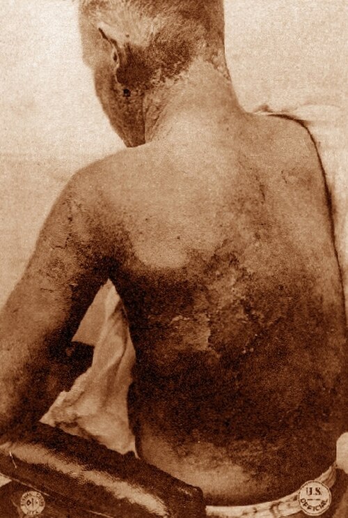 جندي مصاب بحروق غاز الخردل، حوالي عام 1918