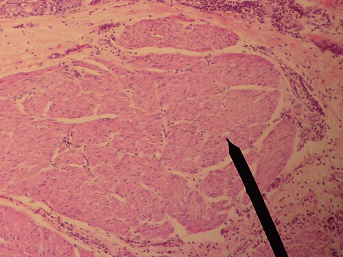 مقطع عرضي لعضلة الصوت