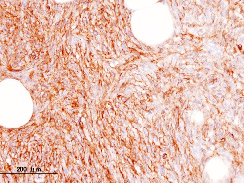 التلوين المناعي إيجابي لـ CD34