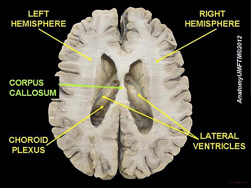 الجسم الثفني