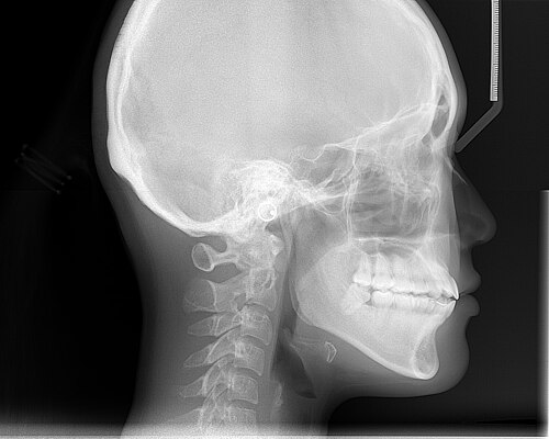 صورة أشعة سينية تم التقاطها لتحليل الجمجمة