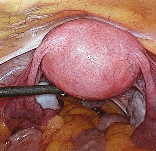 Photograph of female reproductive system inside of the abdomen