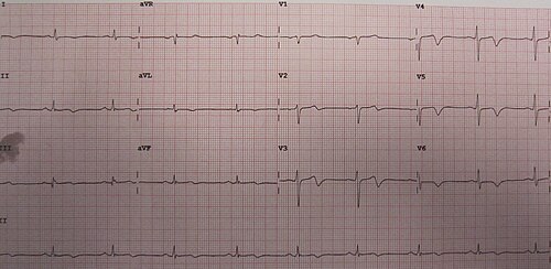 تخطيط كهربية القلب (ECG) لنفس الشخص في حالة عدم وجود ألم، لاحظ موجات T ثنائية الطور في المسارين V2 و V3