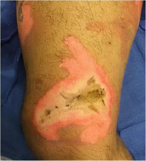 صورة لحرق جلدي في الجزء الداخلي من الفخذ الأيمن فوق الركبة لرجل يبلغ من العمر 35 عامًا.