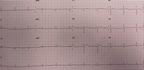 تخطيط كهربية القلب (ECG) لشخص مصاب بمتلازمة ويلنز عند الشعور بألم في الصدر