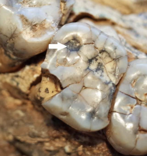 سنٌّ لا يزال في عظم الفك، به شقوق عديدة في جميع أنحائه، والجزء السفلي الأيسر منه مكسور. يوجد سهم أبيض يشير إلى دائرة سوداء بارزة على السن العلوي الأيسر.