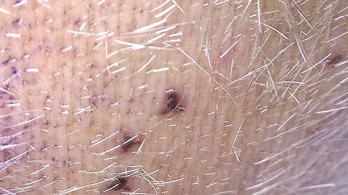 لدغات علق حمراء مكبرة على ضرع بقرة